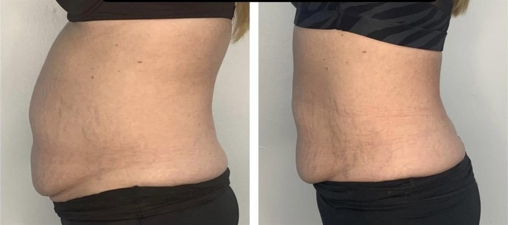 Post-pregnancy stomach tightening before and after