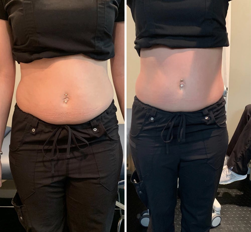 Male abdomen fat loss before and after
